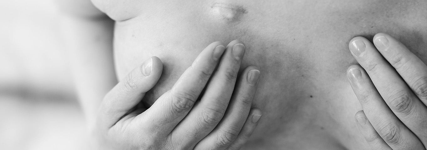 Embracing Progress: CMS Upholds Vital S-Codes for Autologous Breast Reconstruction