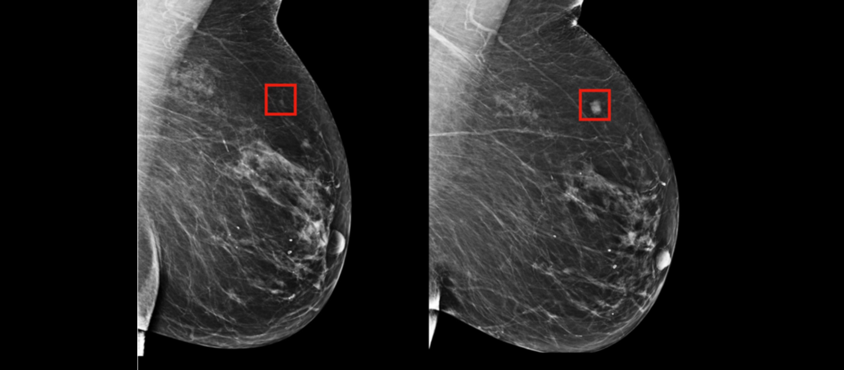 Will AI Redefine the Future of Breast Cancer Screening? – Everviolet